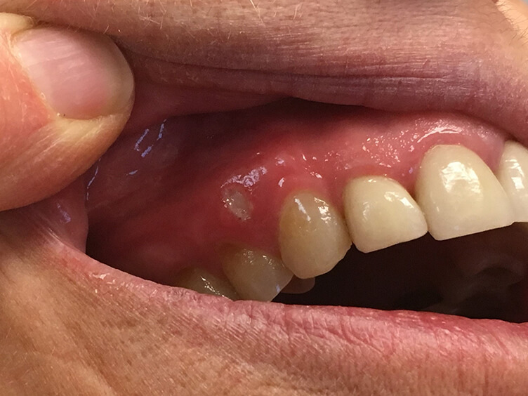 علائم آفت دهان چیست